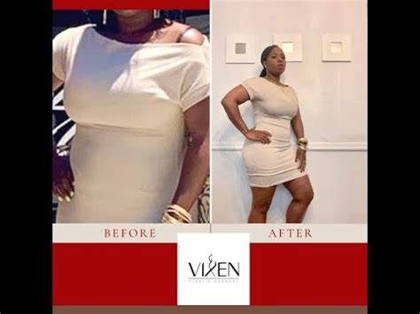 An investigation by USA Today and the Naples Daily News found that the cosmetic. . Vixen plastic surgery reviews